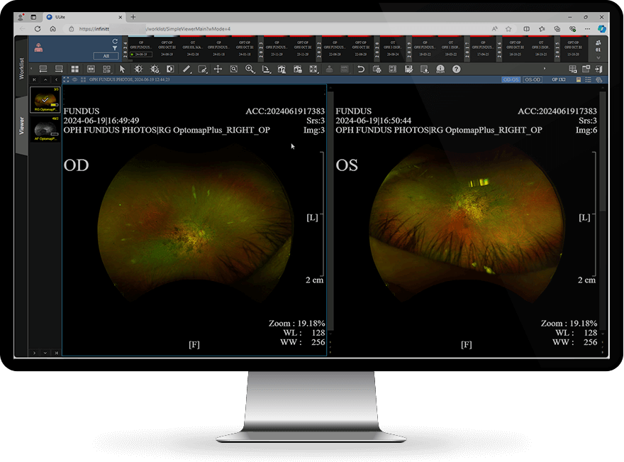 Ophth-FUNDUS-OD-OS-Monitor