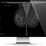 Rad-Breast-Mammo-1