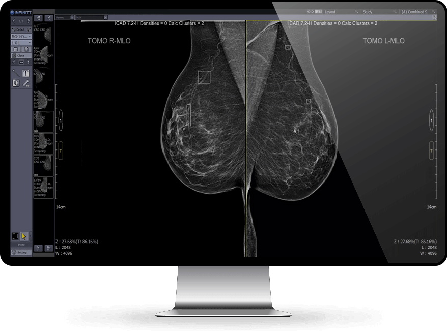 Rad-Breast-Mammo-1