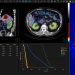 dosemap-in-affinity-with-dvh-and-auto-regions-screenshot